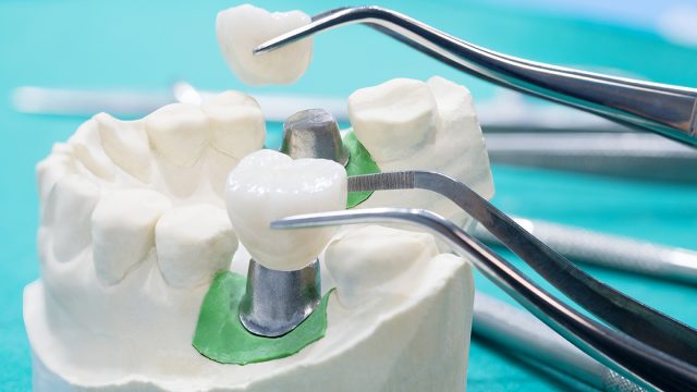 Bridge Dentaire Collé : quel remboursement par l’assurance maladie et la mutuelle santé ?