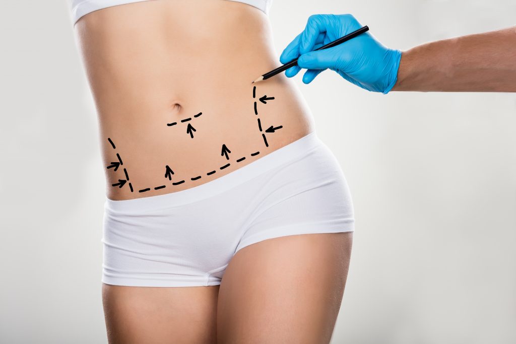 chirurgien dessinant des traits de correction sur le ventre d'une femme en vue d'une abdominoplastie