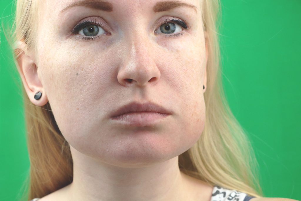 Femme avec les joues gonflés après une opération des dents de sagesse
