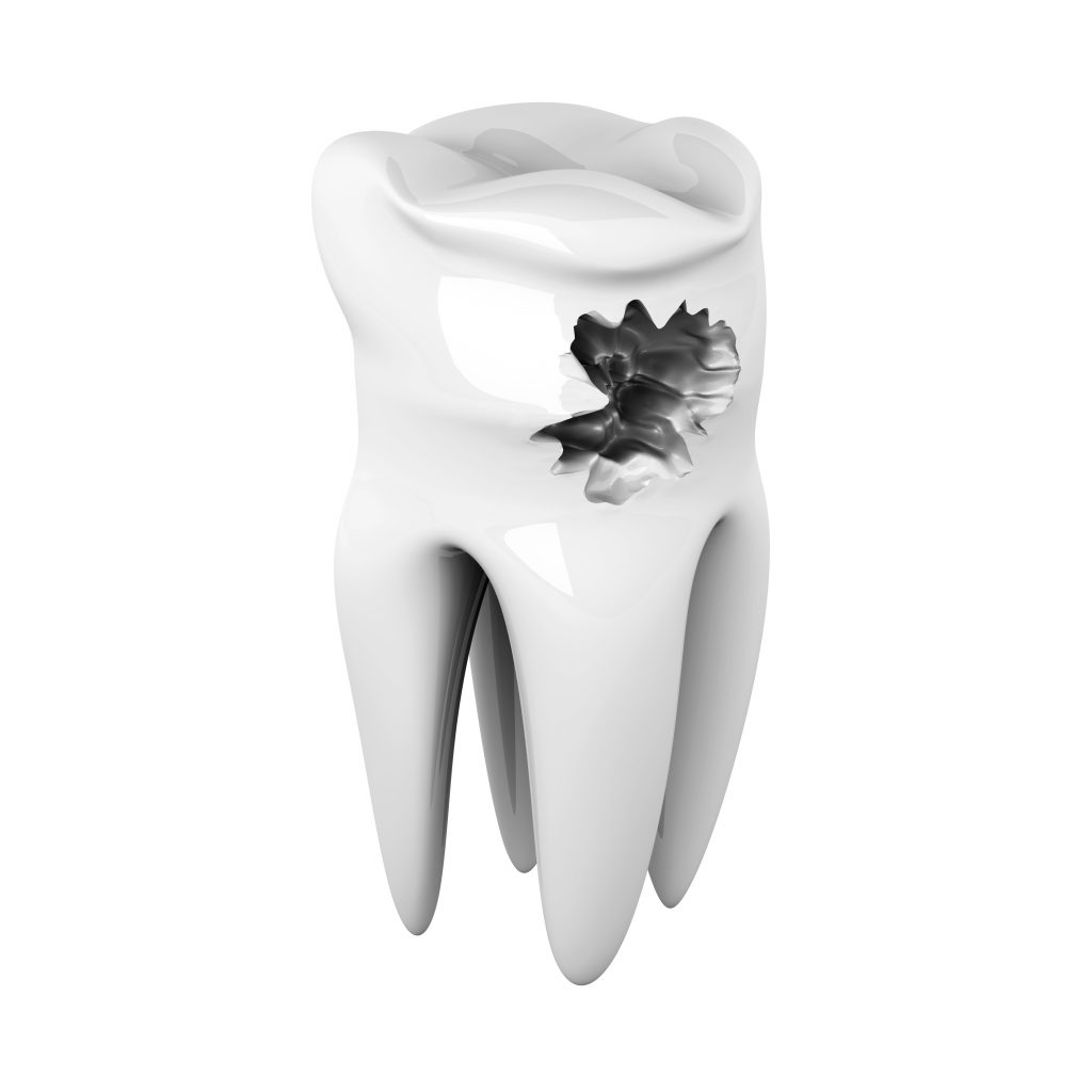 dessin 3D d'une dent avec une carie