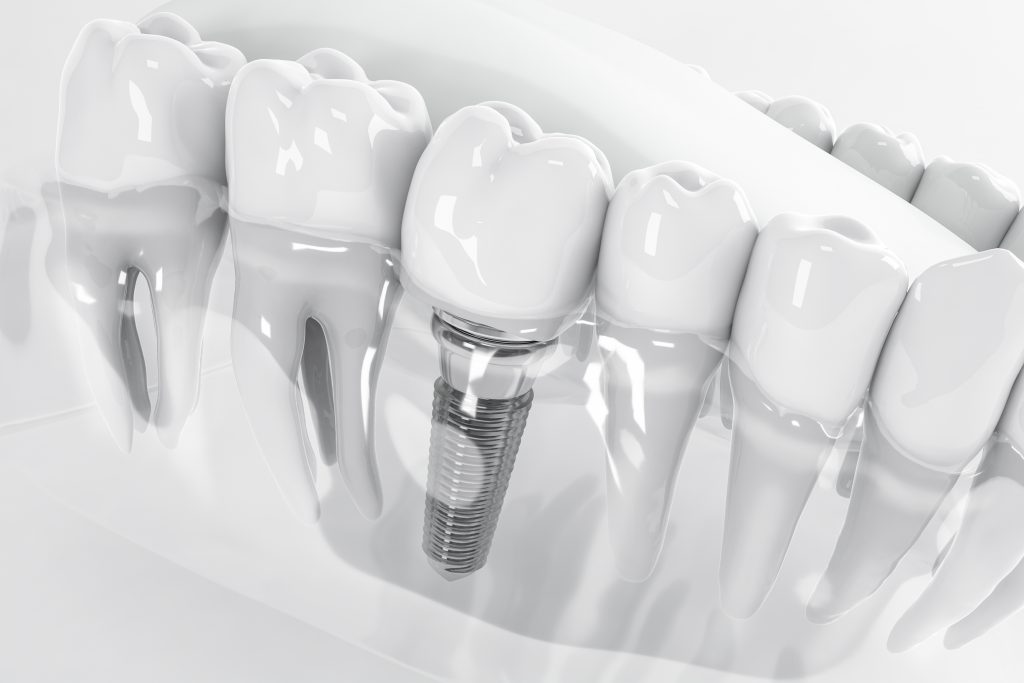 illustration 3D d'implant dentaire